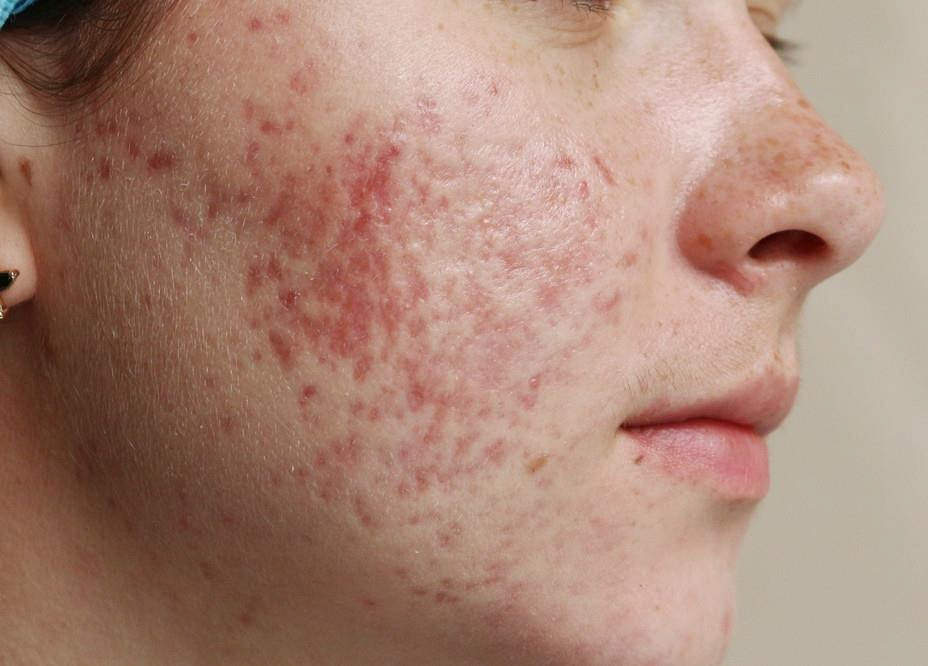 Краткий обзор крутых средств для избавления от угрей на коже
