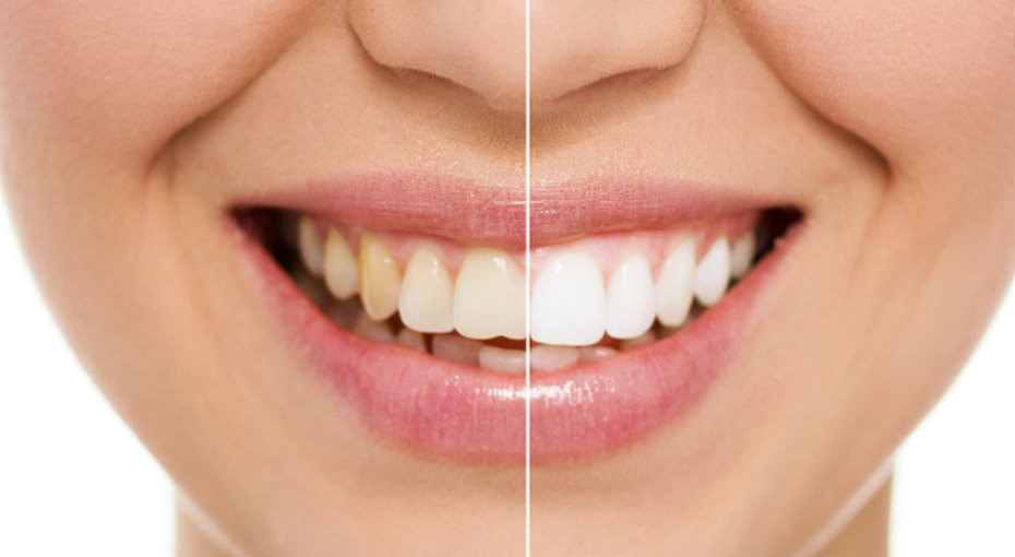 Отбеливание зубов с невероятным эффектом: 6 домашних методов