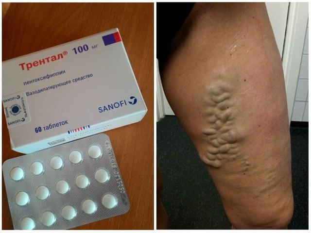 Агапурин и трентал: что лучше и в чем разница (отличие составов, отзывы врачей)