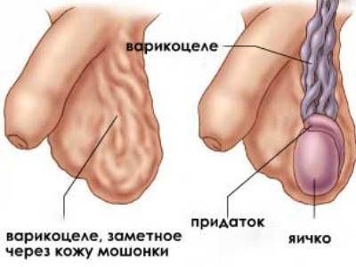 Армия при варикоцеле (1,2,3, степени): отсрочка после операции, служба с заболеванием, обучение на военной кафедре