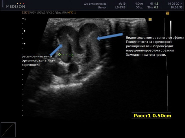 Армия при варикоцеле (1,2,3, степени): отсрочка после операции, служба с заболеванием, обучение на военной кафедре