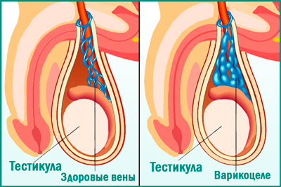 Армия при варикоцеле (1,2,3, степени): отсрочка после операции, служба с заболеванием, обучение на военной кафедре