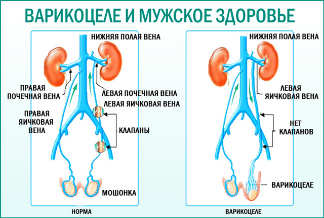 Армия при варикоцеле (1,2,3, степени): отсрочка после операции, служба с заболеванием, обучение на военной кафедре