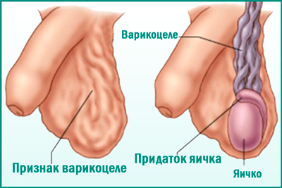 Армия при варикоцеле (1,2,3, степени): отсрочка после операции, служба с заболеванием, обучение на военной кафедре