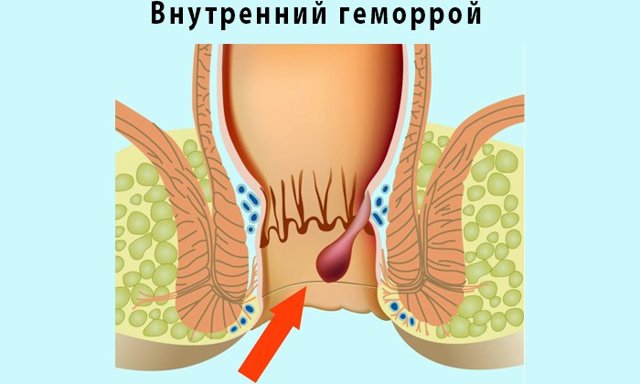 Ауробин и гепатомбин: что лучше и в чем разница (отличие составов, отзывы врачей)