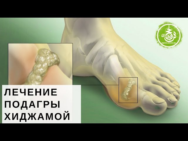 Баня и подагра: способы эффективного лечения – всё о банях