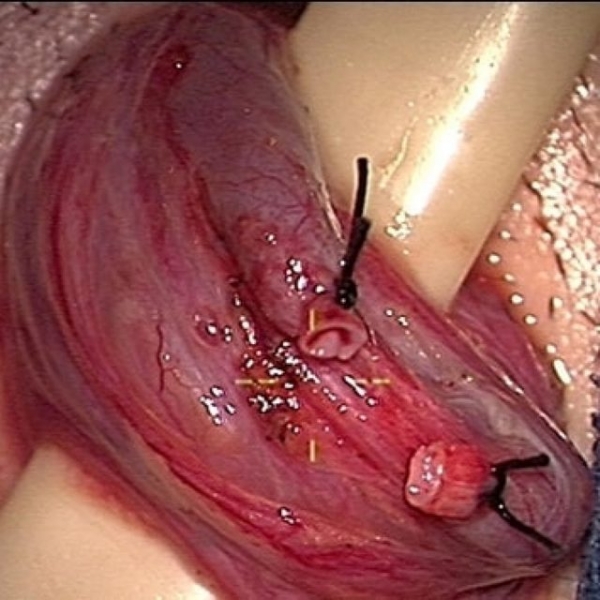 Бесплодие при варикоцеле: причины, лечение и можно ли забеременеть