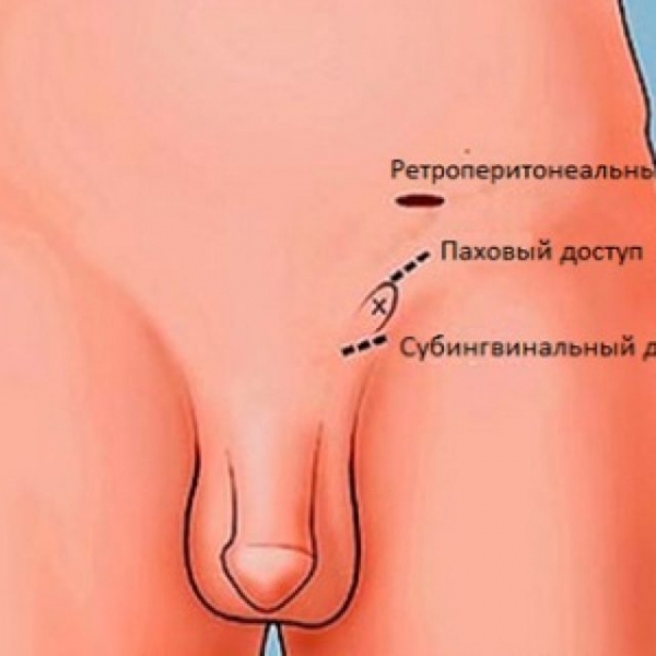 Бесплодие при варикоцеле: причины, лечение и можно ли забеременеть