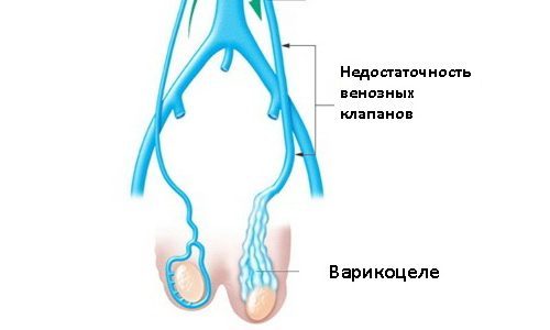 Бесплодие при варикоцеле: причины, лечение и можно ли забеременеть