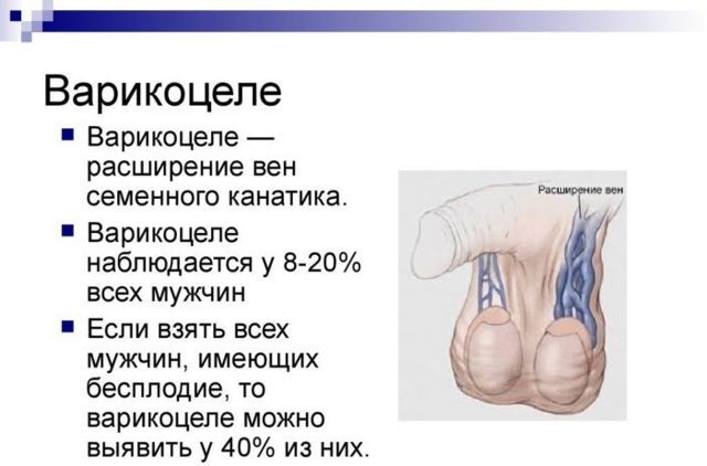 Бесплодие при варикоцеле: причины, лечение и можно ли забеременеть
