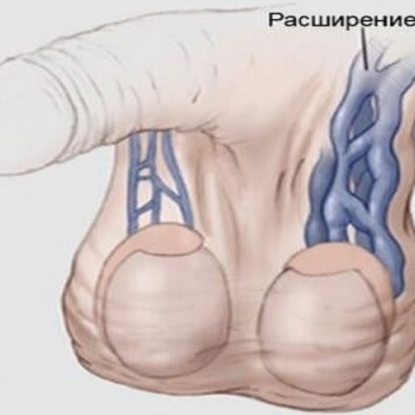 Бесплодие при варикоцеле: причины, лечение и можно ли забеременеть