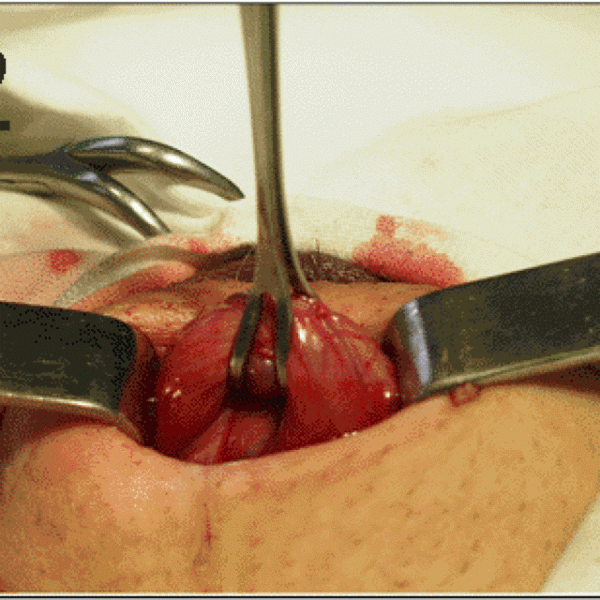 Бесплодие при варикоцеле: причины, лечение и можно ли забеременеть