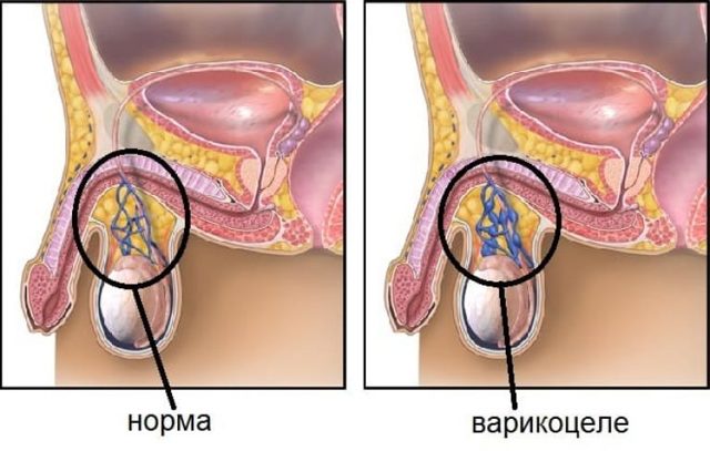 Бесплодие при варикоцеле: причины, лечение и можно ли забеременеть