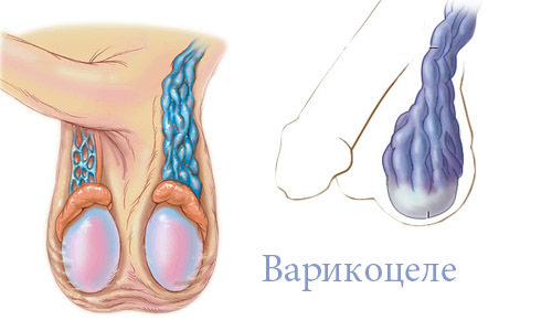 Бесплодие при варикоцеле: причины, лечение и можно ли забеременеть