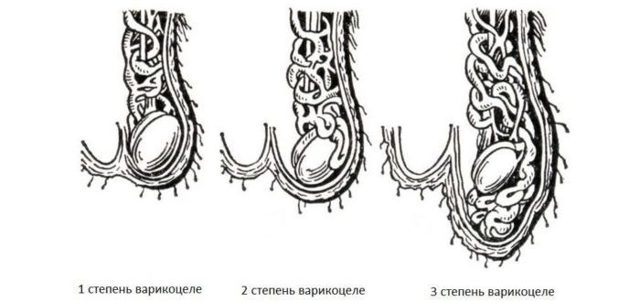Бесплодие при варикоцеле: причины, лечение и можно ли забеременеть