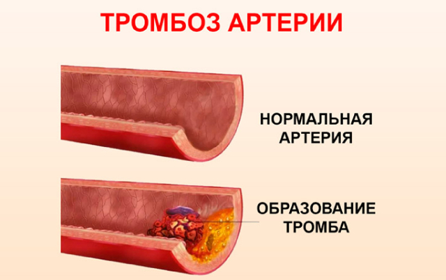 Безорнил и гепатромбин: что лучше и в чем разница (отличие составов, отзывы врачей)