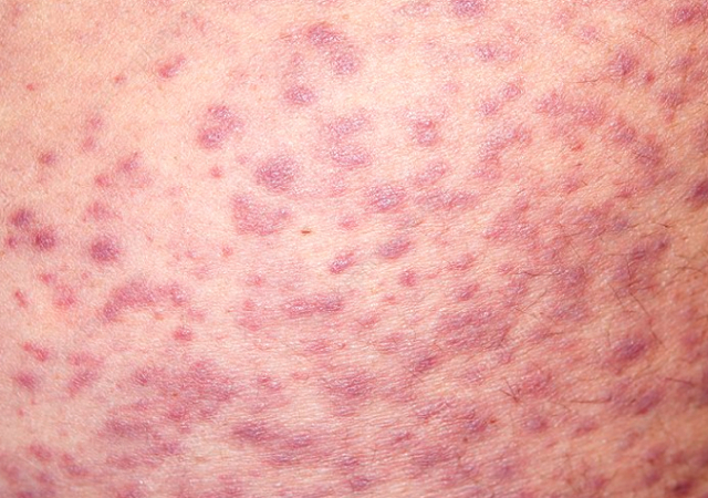 Безорнил и гепатромбин: что лучше и в чем разница (отличие составов, отзывы врачей)