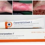 Безорнил и гепатромбин: что лучше и в чем разница (отличие составов, отзывы врачей)