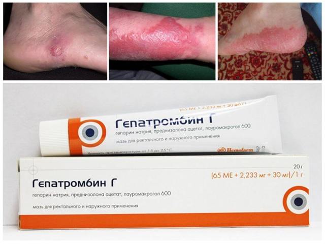 Безорнил и гепатромбин: что лучше и в чем разница (отличие составов, отзывы врачей)