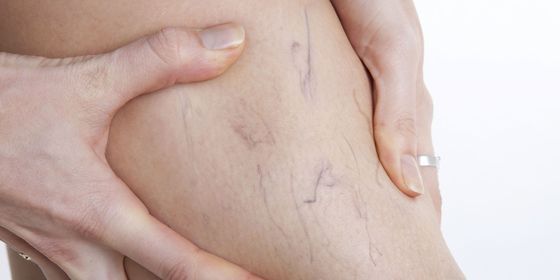 Боли в ногах при варикозе: симптомы (как болит), почему и как обезбаливать