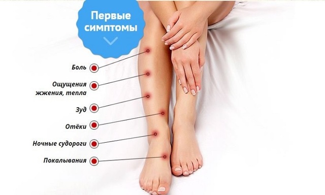 Боли в ногах при варикозе: симптомы (как болит), почему и как обезбаливать