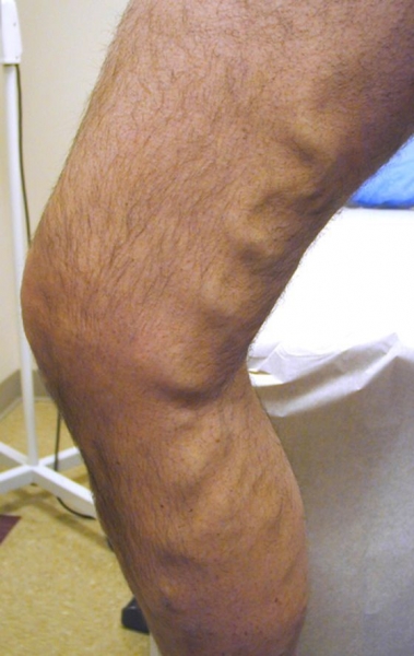 Боли в ногах при варикозе: симптомы (как болит), почему и как обезбаливать