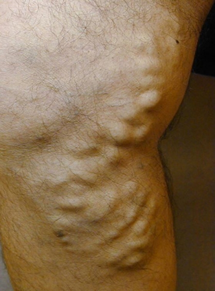 Боли в ногах при варикозе: симптомы (как болит), почему и как обезбаливать