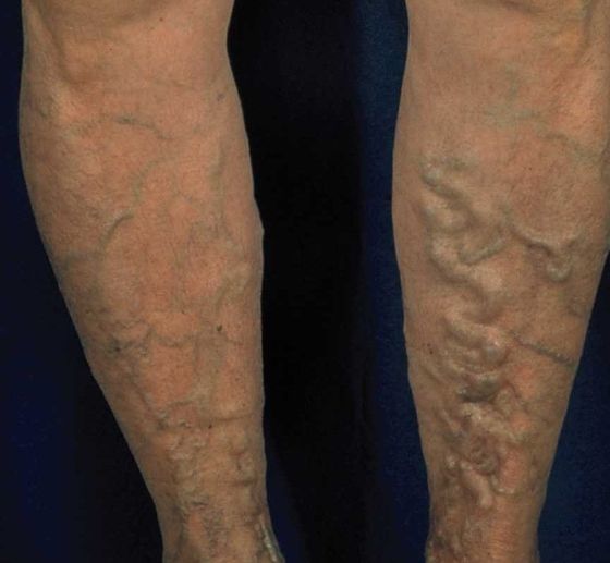 Боли в ногах при варикозе: симптомы (как болит), почему и как обезбаливать