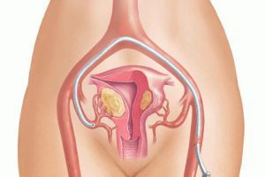 Что такое варикоз матки: как лечить,чем опасен, причины