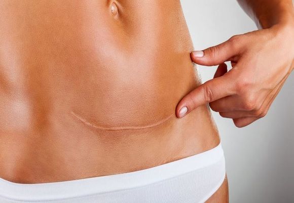 Что такое варикоз матки: как лечить,чем опасен, причины