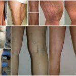 Дарсонваль при варикозе: как пользоваться, противопоказания, отзывы