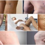 Дарсонваль при варикозе: как пользоваться, противопоказания, отзывы