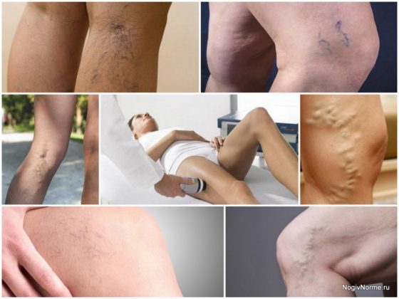 Дарсонваль при варикозе: как пользоваться, противопоказания, отзывы