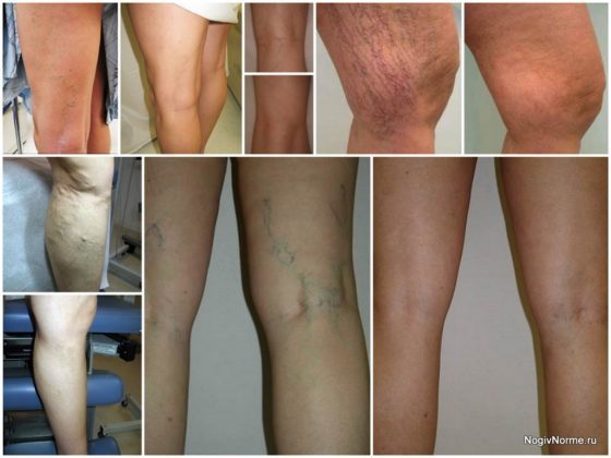 Дарсонваль при варикозе: как пользоваться, противопоказания, отзывы