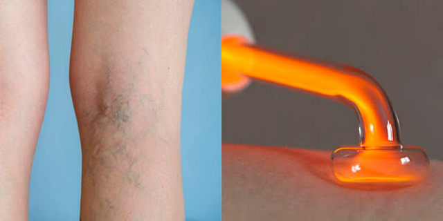 Дарсонваль при варикозе: как пользоваться, противопоказания, отзывы