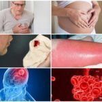 Дарсонваль при варикозе: как пользоваться, противопоказания, отзывы