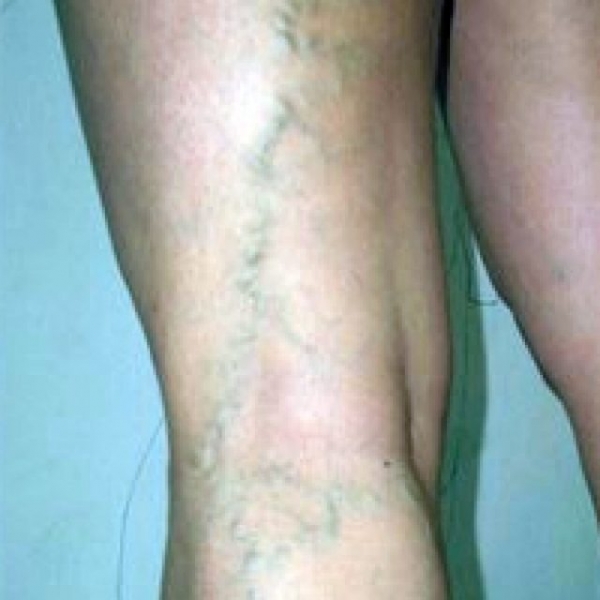 Дарсонваль при варикозе: как пользоваться, противопоказания, отзывы