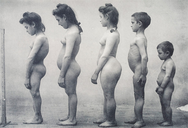 Дефицит витамина д у детей