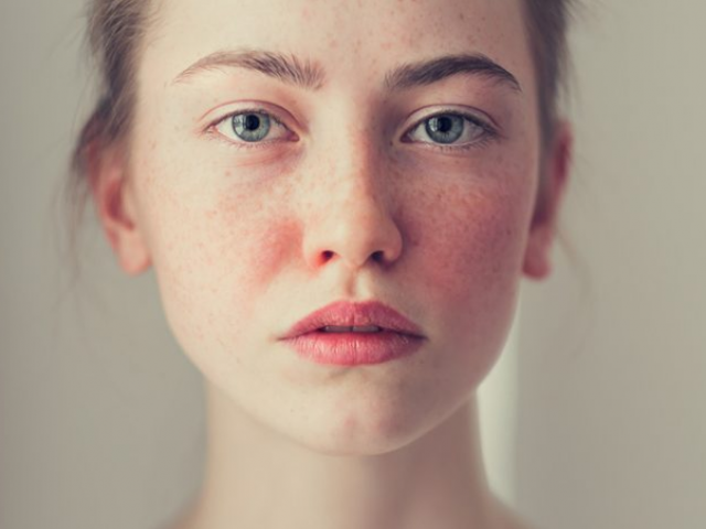 Диета при розацеа