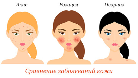 Диета при розацеа