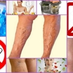 Диета при тромбофлебите глубоких вен нижних конечностей