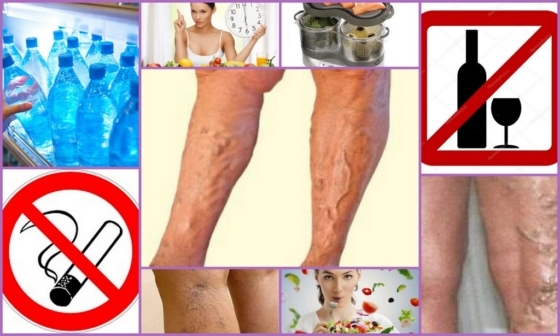 Диета при тромбофлебите глубоких вен нижних конечностей