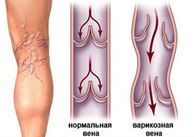 Диета при варикозе: правильное питание(что можно, что нельзя), меню на неделю