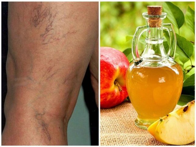 Диета при варикозе: правильное питание(что можно, что нельзя), меню на неделю