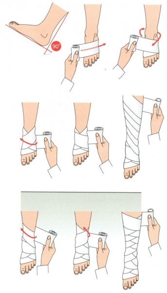 Эластичный бинт при варикозе: правила использования, виды (компрессионные, лаума, интекс), бинты после операции