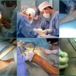 Флебэктомия (венэктомия): виды и ход операции, послеоперационный период, показания