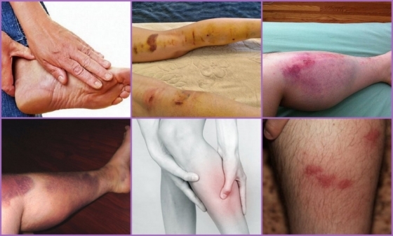 Флебэктомия (венэктомия): виды и ход операции, послеоперационный период, показания