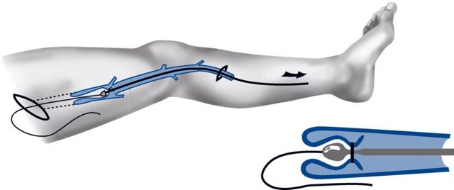 Флебэктомия (венэктомия): виды и ход операции, послеоперационный период, показания