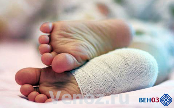 Флебэктомия (венэктомия): виды и ход операции, послеоперационный период, показания