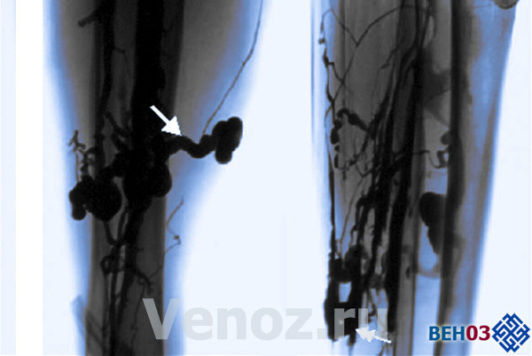 Флебэктомия (венэктомия): виды и ход операции, послеоперационный период, показания